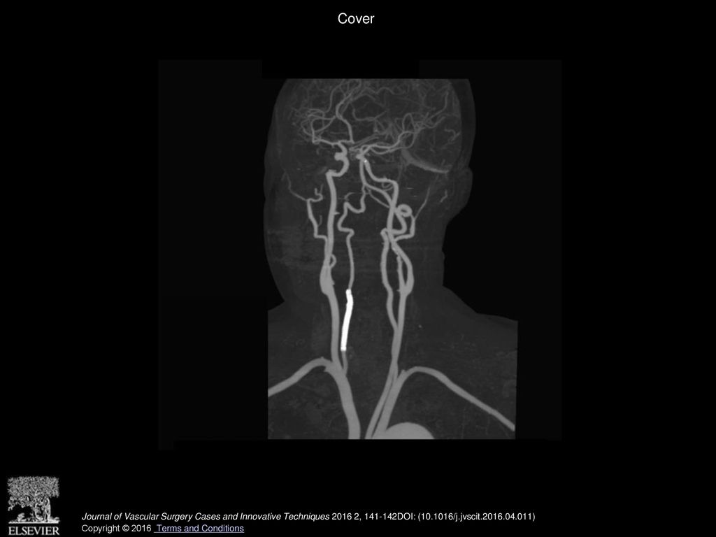 Cover Journal of Vascular Surgery Cases and Innovative Techniques , DOI: ( /j.jvscit )