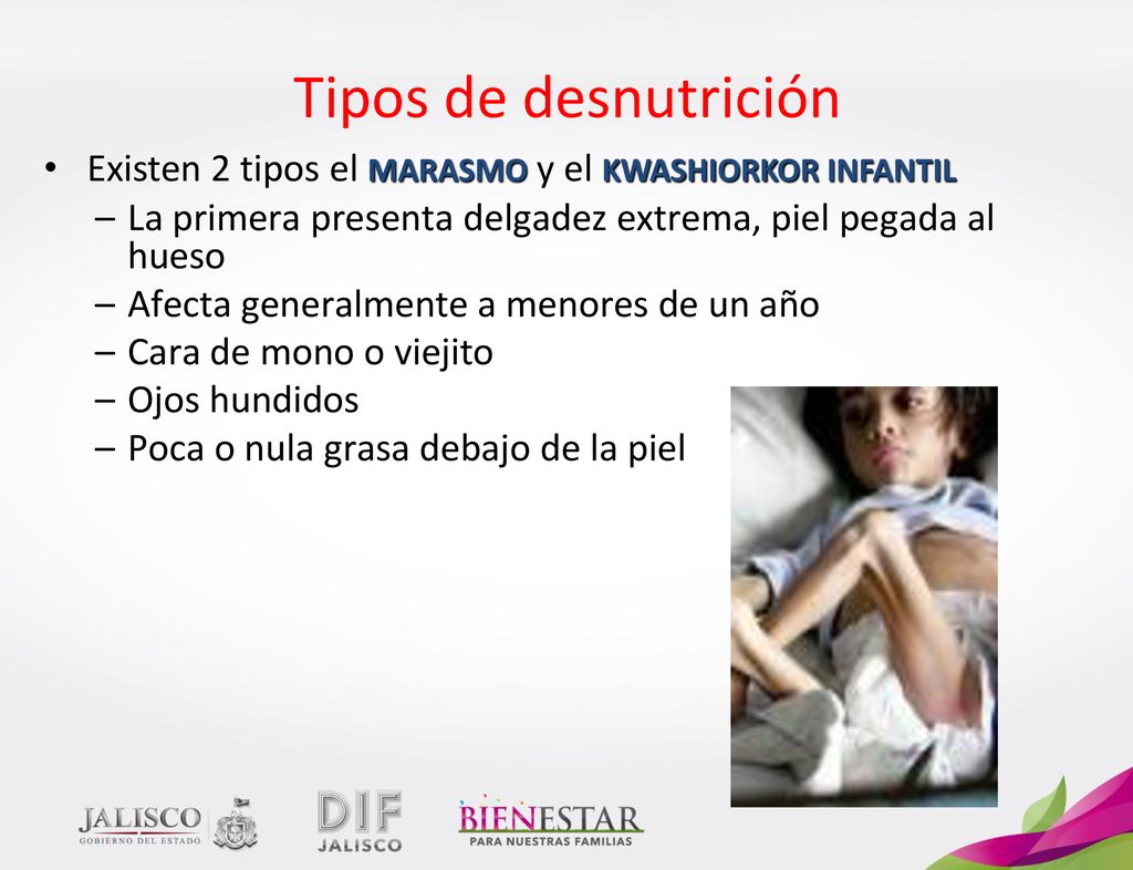 Tipos de desnutrición Existen 2 tipos el MARASMO y el KWASHIORKOR INFANTIL. La primera presenta delgadez extrema, piel pegada al hueso.