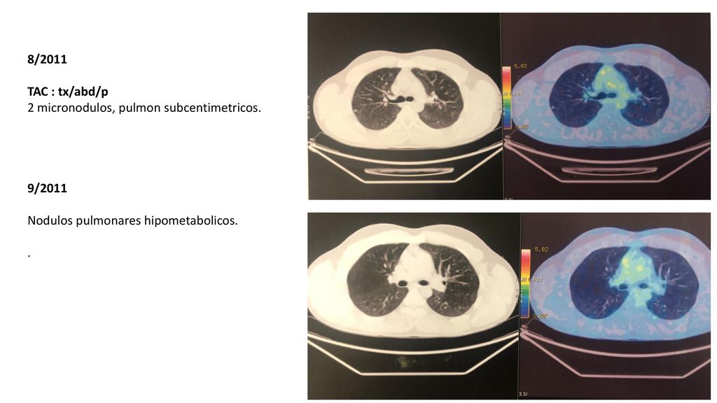 8/2011 TAC : tx/abd/p. 2 micronodulos, pulmon subcentimetricos. 9/2011. Nodulos pulmonares hipometabolicos.