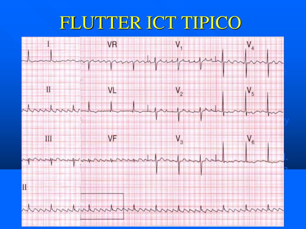 FLUTTER ICT TIPICO Patrón en dientes de sierra con ondas F invertidas en DII, DIII y aVF. Bifásicas en aVL y DI.