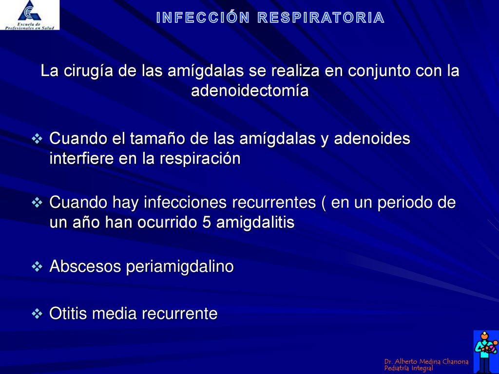 La cirugía de las amígdalas se realiza en conjunto con la adenoidectomía