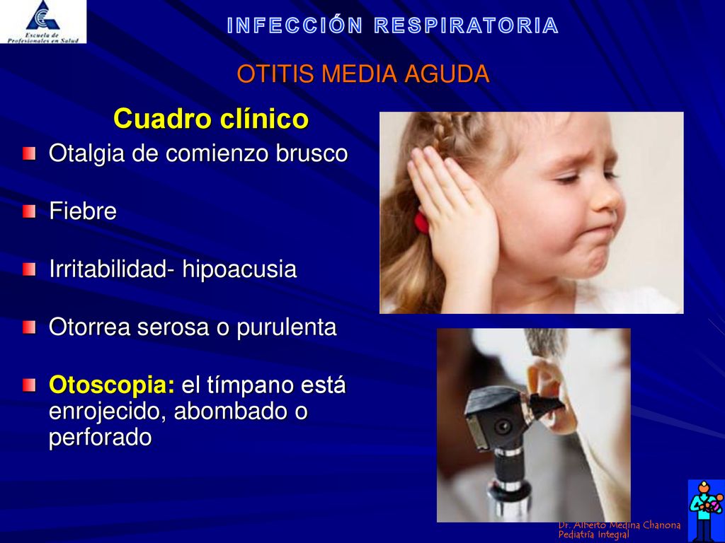 Cuadro clínico OTITIS MEDIA AGUDA Otalgia de comienzo brusco Fiebre