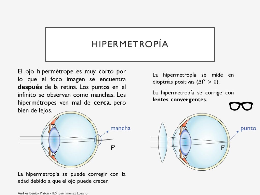 Hipermetropía F’ Andrés Benito Platón - IES José Jiménez Lozano