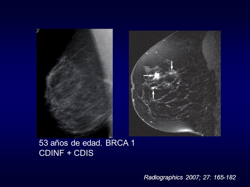 53 años de edad. BRCA 1 CDINF + CDIS Radiographics 2007; 27: