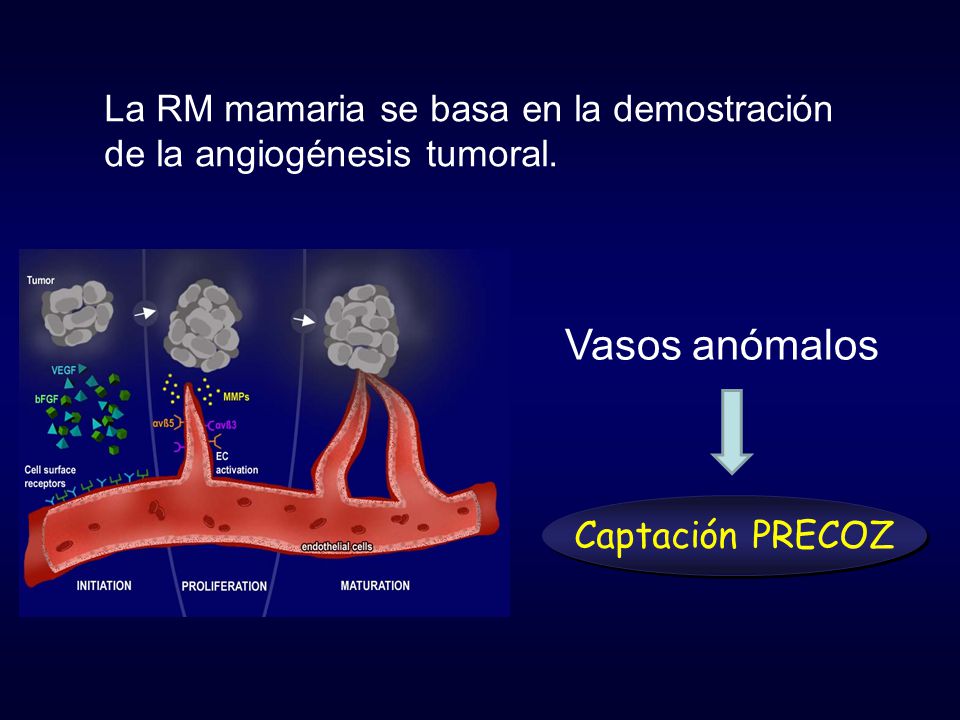 Vasos anómalos La RM mamaria se basa en la demostración
