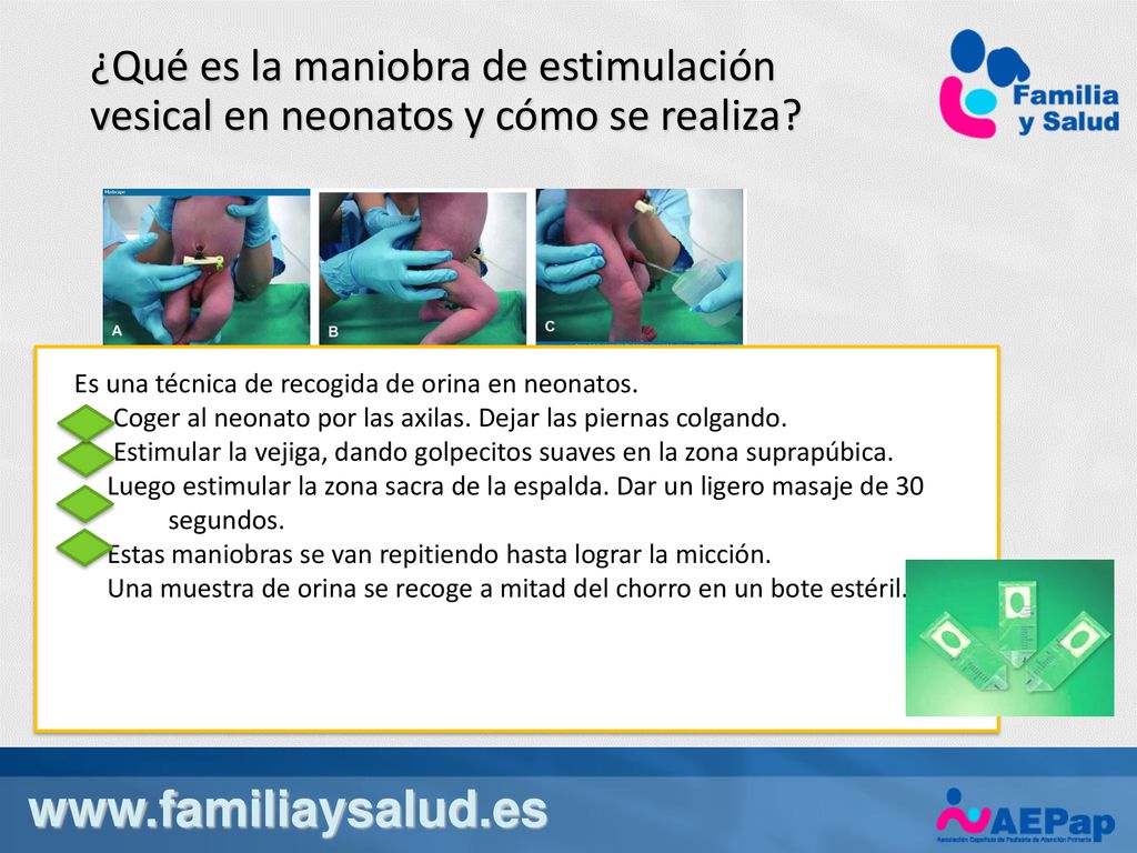 ¿Qué es la maniobra de estimulación vesical en neonatos y cómo se realiza