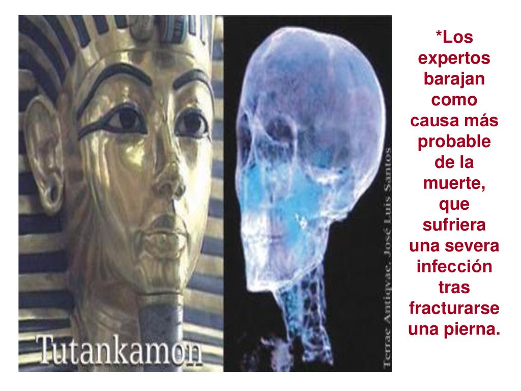*Los expertos barajan como causa más probable de la muerte, que sufriera una severa infección tras fracturarse una pierna.