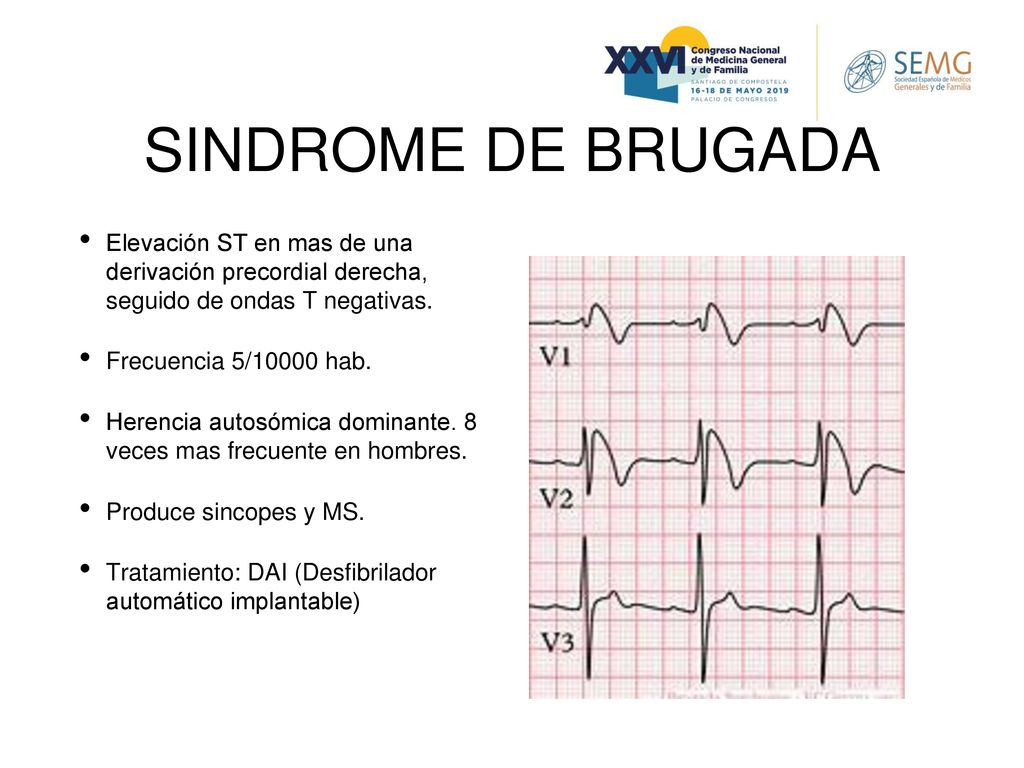 SINDROME DE BRUGADA Elevación ST en mas de una derivación precordial derecha, seguido de ondas T negativas.