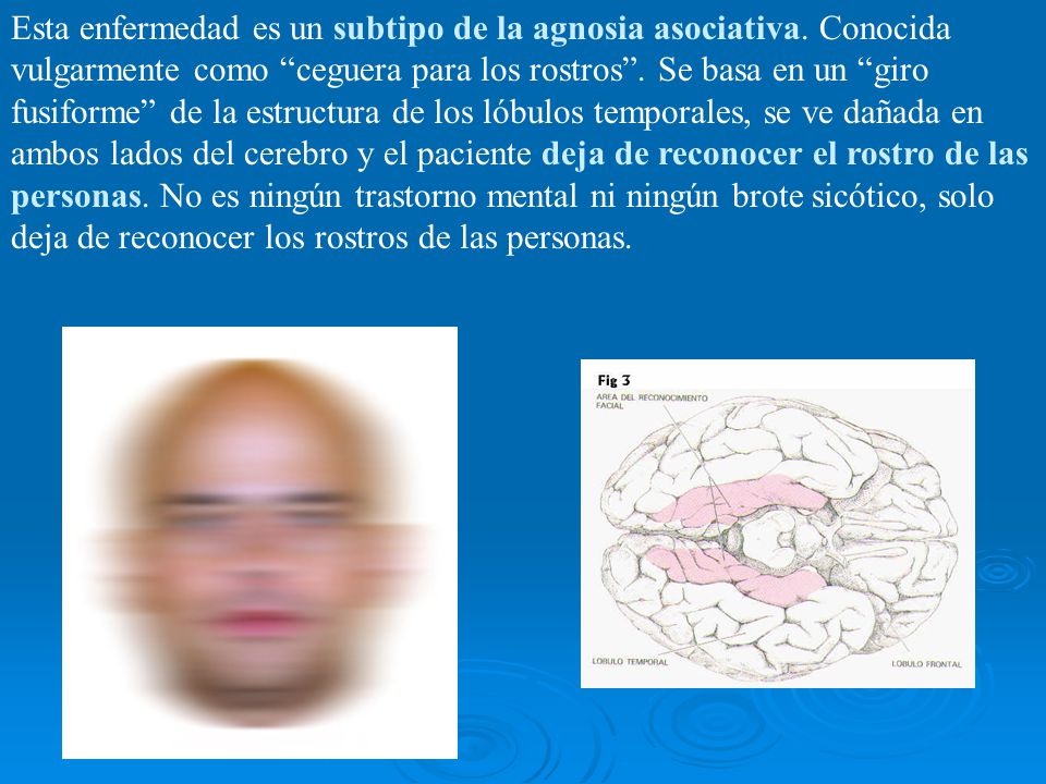 Esta enfermedad es un subtipo de la agnosia asociativa