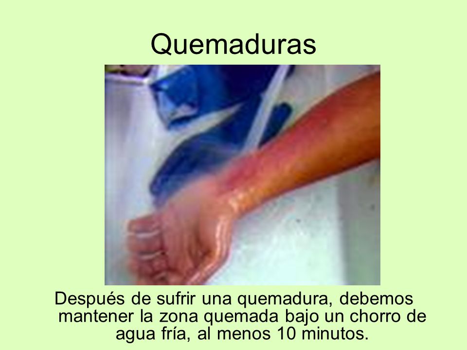Quemaduras Después de sufrir una quemadura, debemos mantener la zona quemada bajo un chorro de agua fría, al menos 10 minutos.