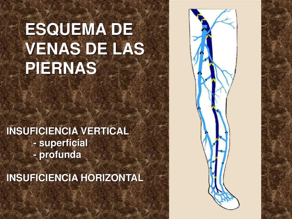 ESQUEMA DE VENAS DE LAS PIERNAS INSUFICIENCIA VERTICAL - superficial