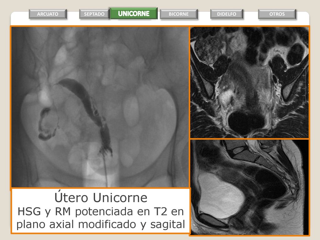 HSG y RM potenciada en T2 en plano axial modificado y sagital