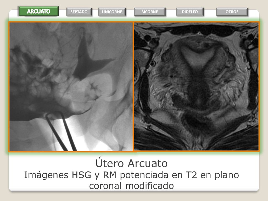 Imágenes HSG y RM potenciada en T2 en plano coronal modificado