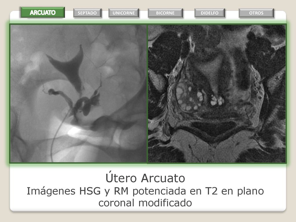 Imágenes HSG y RM potenciada en T2 en plano coronal modificado