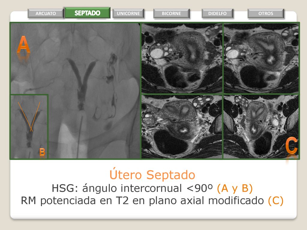 a C Útero Septado B HSG: ángulo intercornual <90º (A y B)