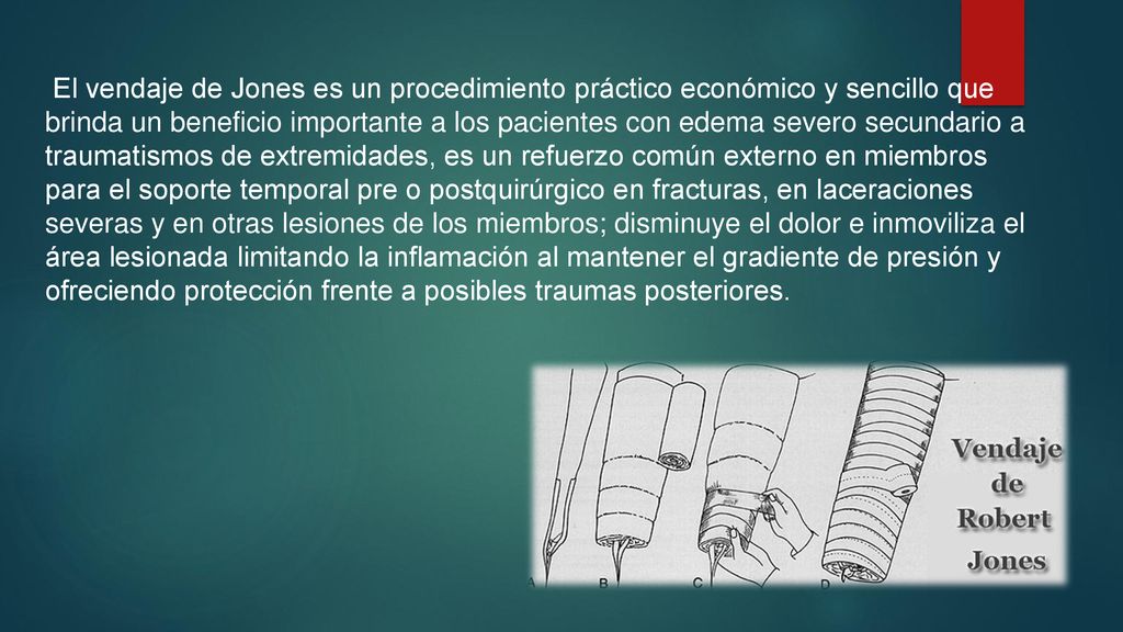 El vendaje de Jones es un procedimiento práctico económico y sencillo que brinda un beneficio importante a los pacientes con edema severo secundario a traumatismos de extremidades, es un refuerzo común externo en miembros para el soporte temporal pre o postquirúrgico en fracturas, en laceraciones severas y en otras lesiones de los miembros; disminuye el dolor e inmoviliza el área lesionada limitando la inflamación al mantener el gradiente de presión y ofreciendo protección frente a posibles traumas posteriores.