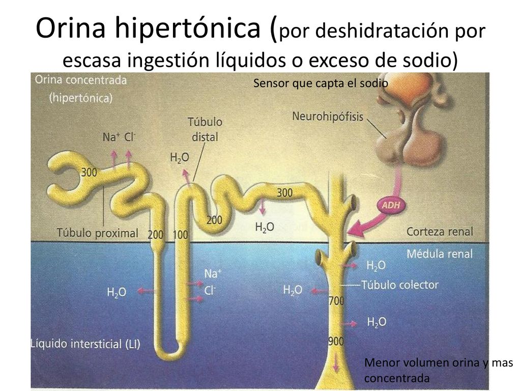 Orina hipertónica (por deshidratación por escasa ingestión líquidos o exceso de sodio)