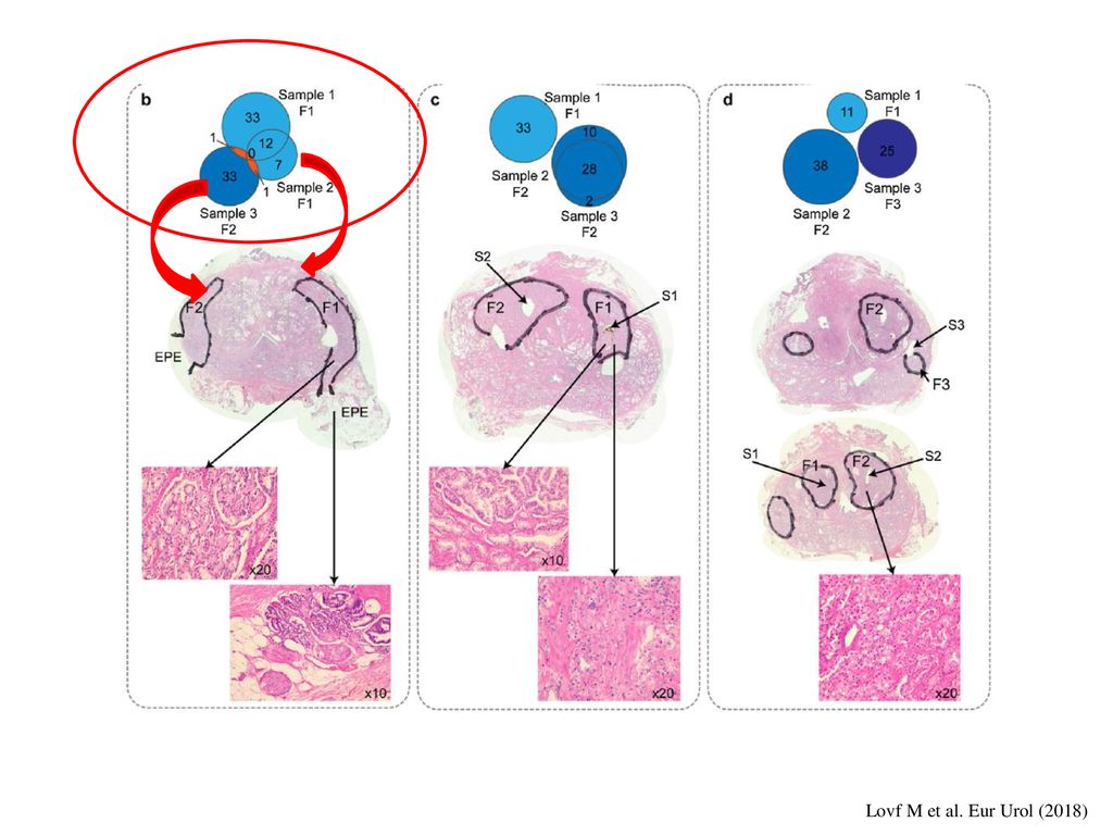 Ejemplos de pacientes en los cuales los diagramas de ven muestran el numero de mutaciones identificadas in cada muestra y como se encuentran distribuidas en el tumor y en como se ven los cambios histológicos en cortes de hematoxilina y eosina. Por ejemplo, en el paciente B, las muestras 1 y 2 son del mismo foco tumoral (f1) pero tienen diferentes mutaciones y comparten muy pocas mutaciones con el foco tumoral 2 (f2). Mostrando nuevamente la gran heterogeneidad genómica en los tumores de próstata.
