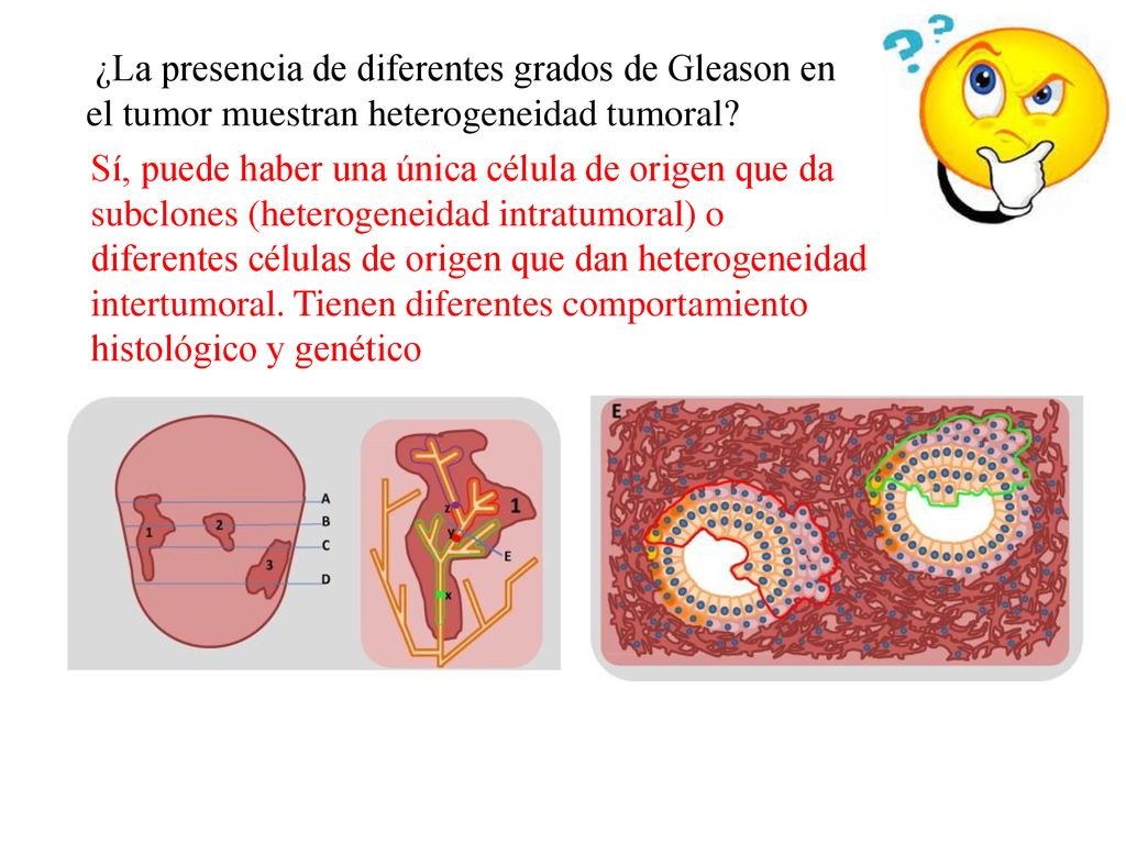 ¿La presencia de diferentes grados de Gleason en el tumor muestran heterogeneidad tumoral