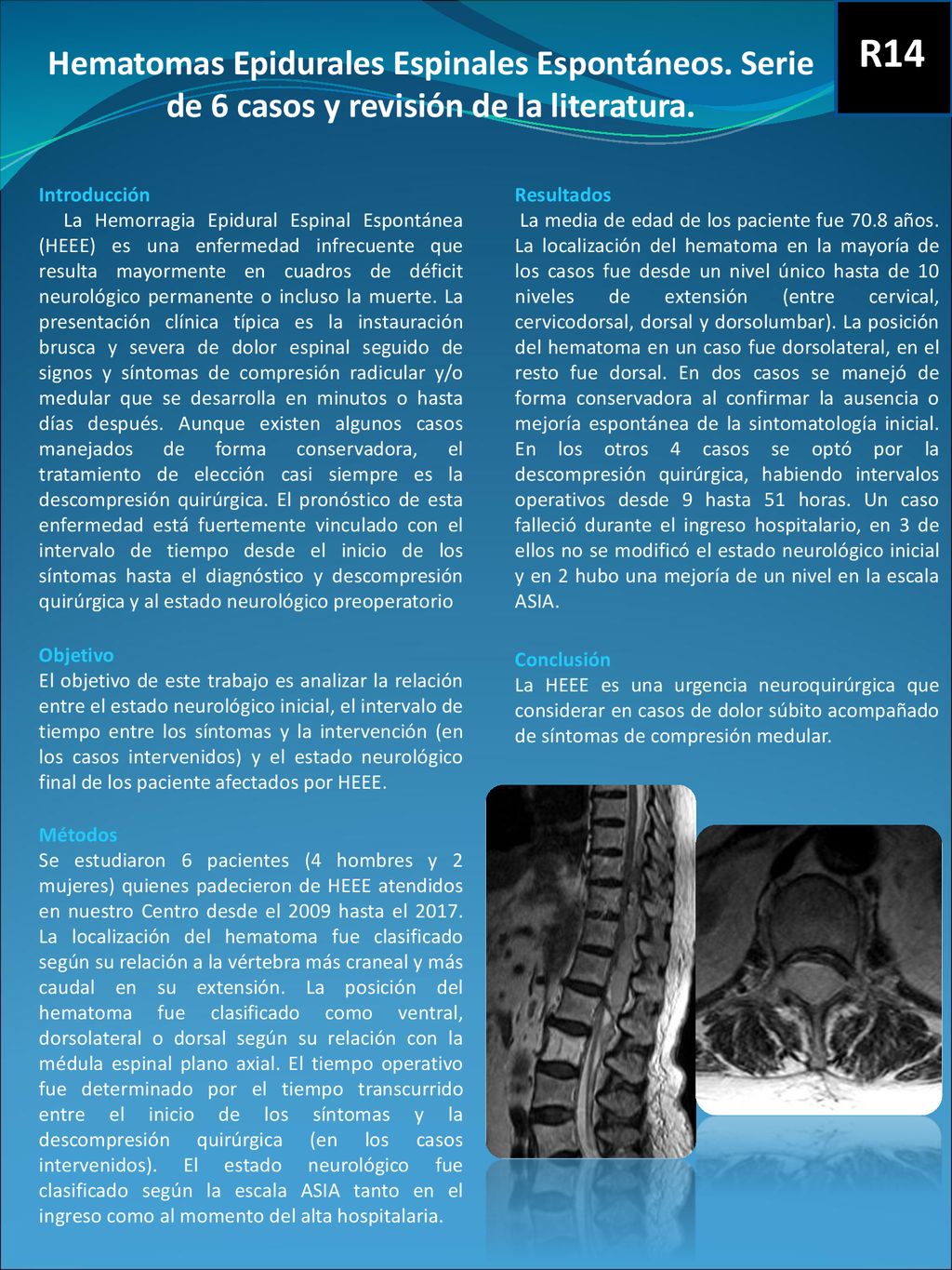 R14 Hematomas Epidurales Espinales Espontáneos. Serie de 6 casos y revisión de la literatura. Introducción.
