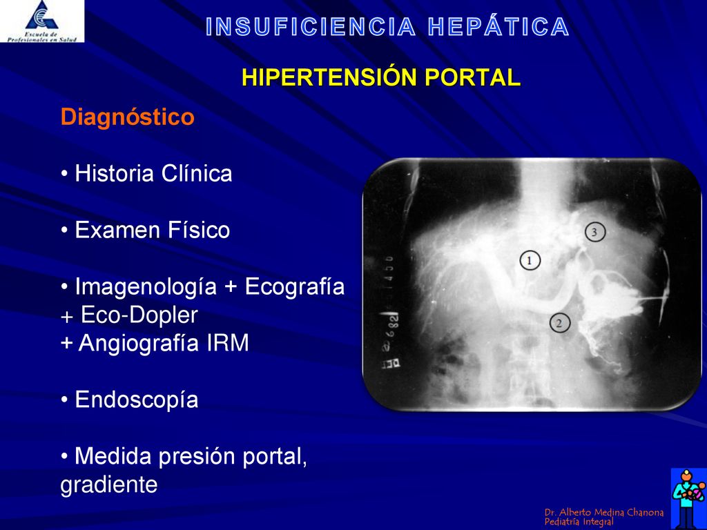 HIPERTENSIÓN PORTAL Diagnóstico. • Historia Clínica. • Examen Físico. • Imagenología + Ecografía.