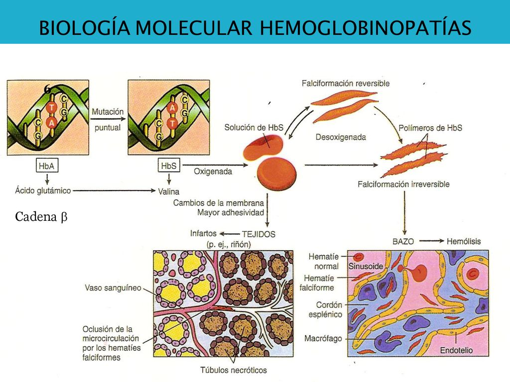 Anemia Falciforme, Drepanocítica, en Forma de Hoz (sickle), o HbS