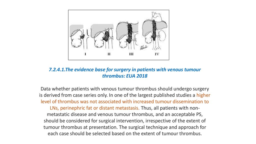 The evidence base for surgery in patients with venous tumour thrombus: EUA 2018