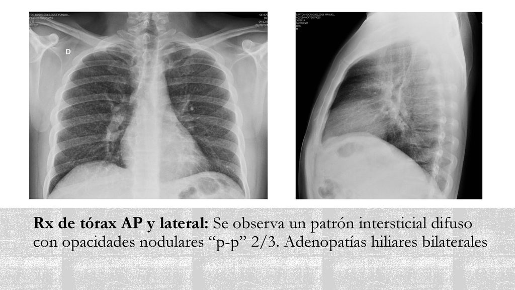 Rx de tórax AP y lateral: Se observa un patrón intersticial difuso con opacidades nodulares p-p 2/3.