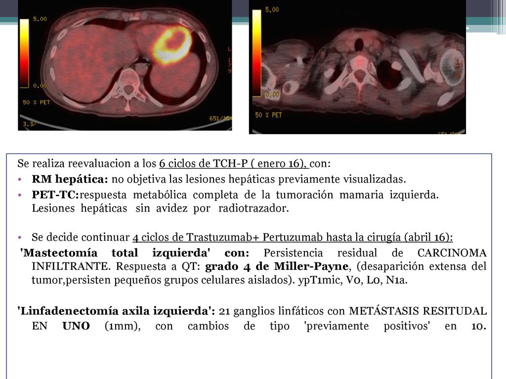 Se realiza reevaluacion a los 6 ciclos de TCH-P ( enero 16), con: