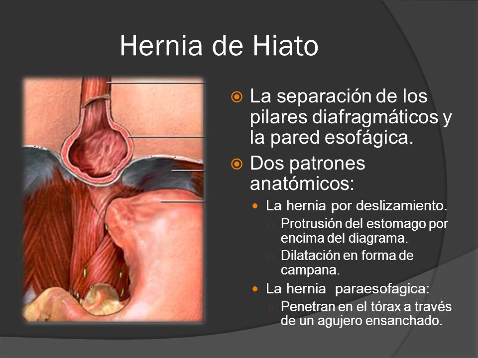 Hernia de Hiato La separación de los pilares diafragmáticos y la pared esofágica. Dos patrones anatómicos: