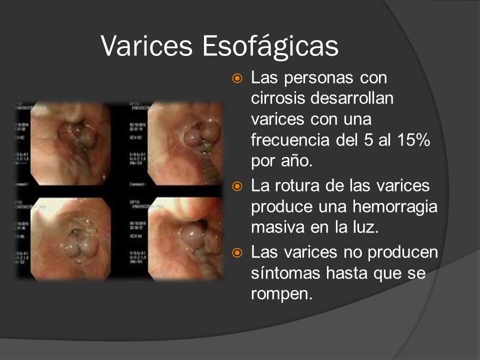 Varices Esofágicas Las personas con cirrosis desarrollan varices con una frecuencia del 5 al 15% por año.