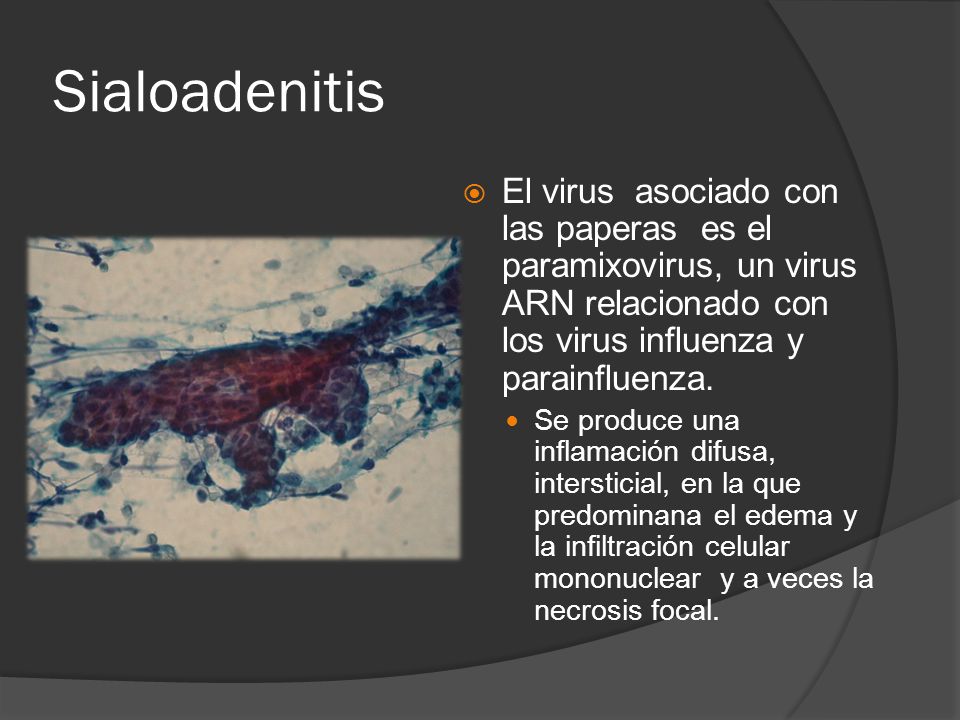 Sialoadenitis El virus asociado con las paperas es el paramixovirus, un virus ARN relacionado con los virus influenza y parainfluenza.