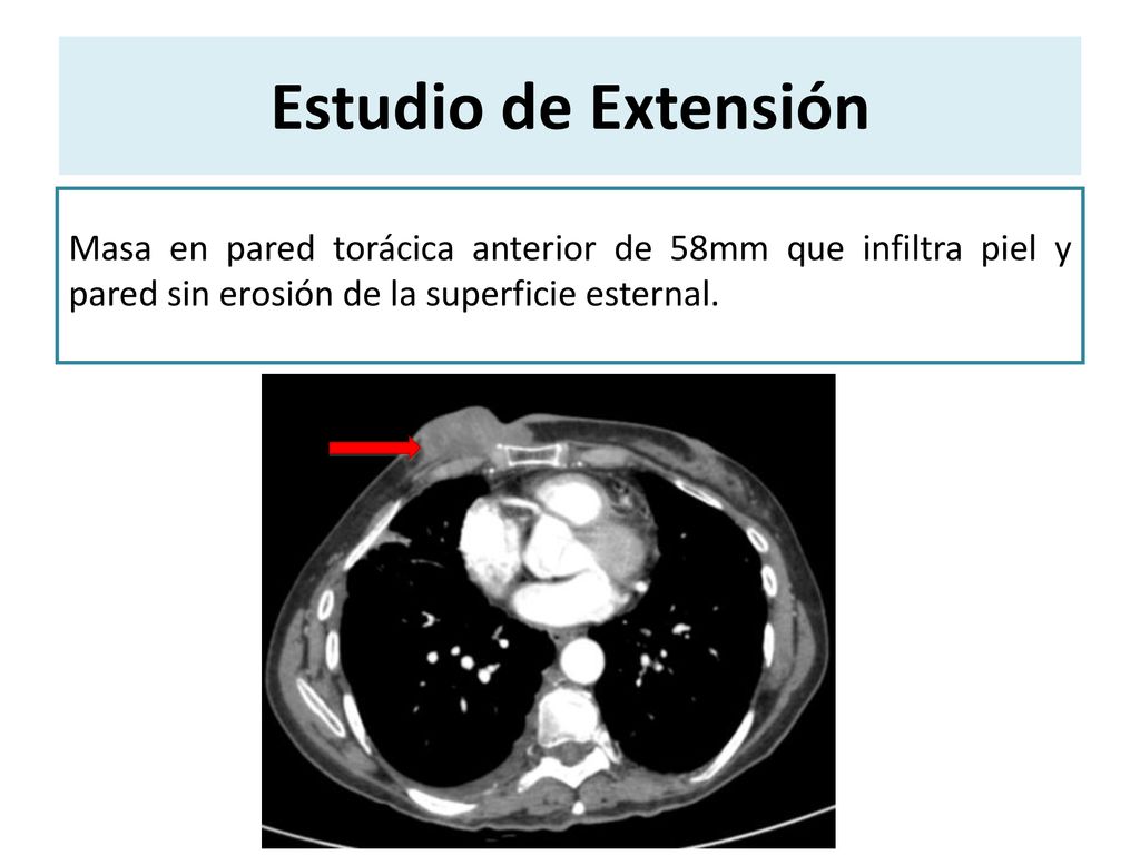 Estudio de Extensión Masa en pared torácica anterior de 58mm que infiltra piel y pared sin erosión de la superficie esternal.