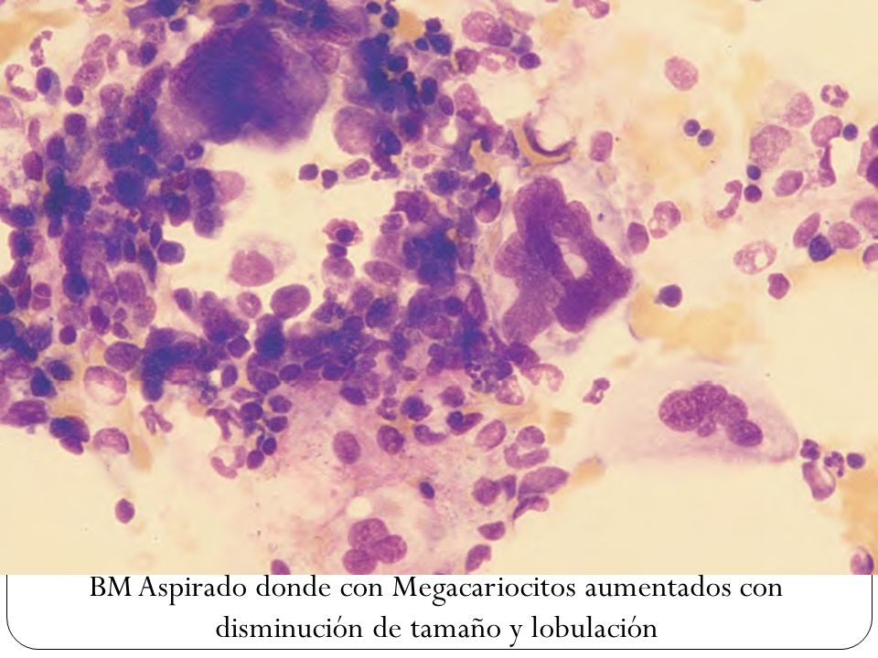 BM Aspirado donde con Megacariocitos aumentados con disminución de tamaño y lobulación