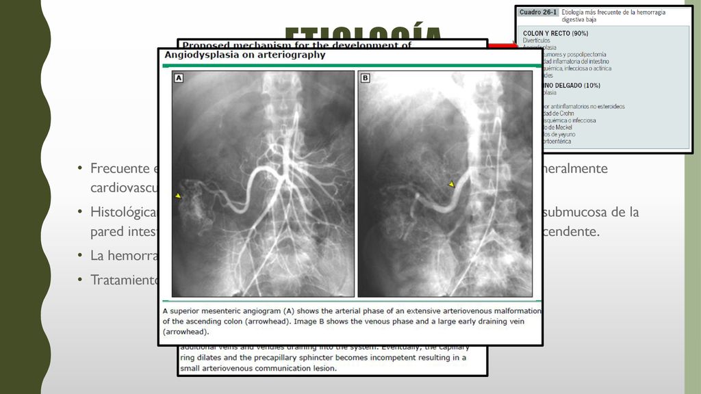 Etiología Frecuente en pacientes mayores de 60 años, con enfermedades asociadas, generalmente cardiovasculares o insuficiencia renal.