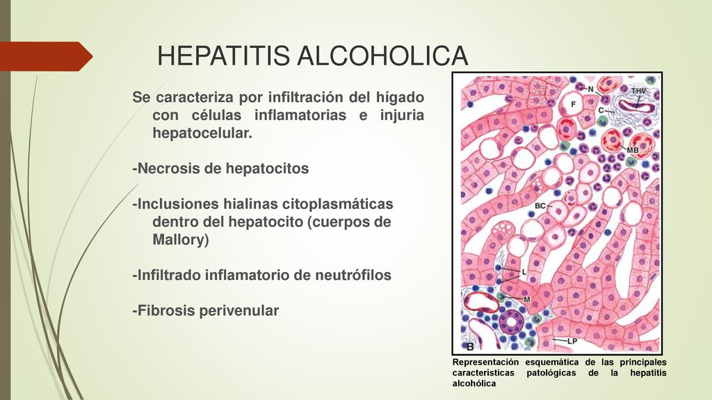 HEPATITIS ALCOHOLICA Se caracteriza por infiltración del hígado con células inflamatorias e injuria hepatocelular.