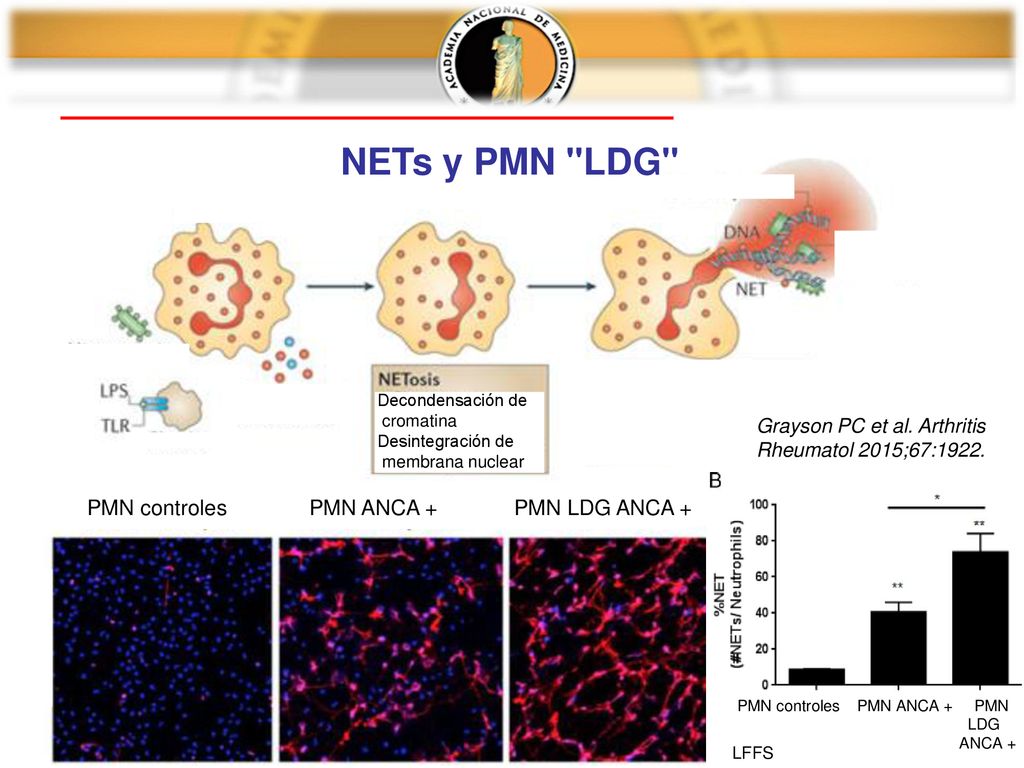 NETs y PMN LDG PMN controles PMN ANCA + PMN LDG ANCA +
