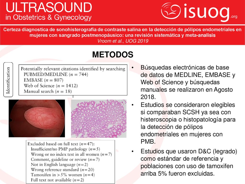 Certeza diagnostica de sonohisterografia de contraste salina en la detección de pólipos endometriales en mujeres con sangrado postmenopáusico: una revisión sistemática y meta-analisis