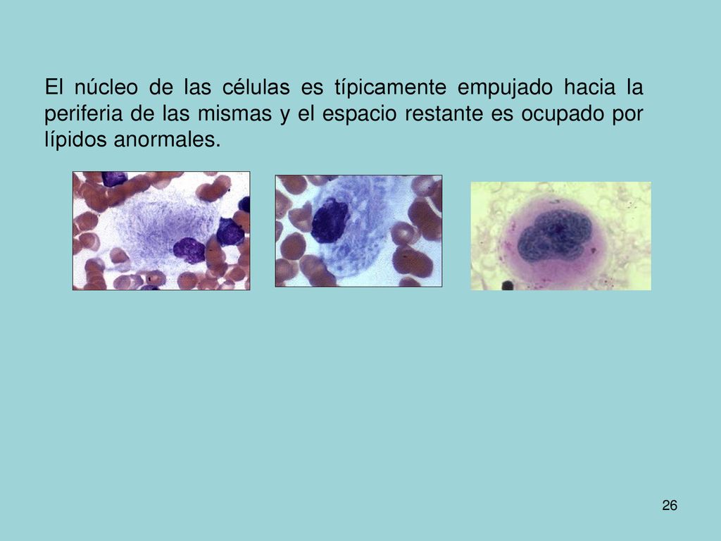 El núcleo de las células es típicamente empujado hacia la periferia de las mismas y el espacio restante es ocupado por lípidos anormales.