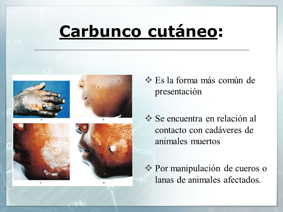 Carbunco cutáneo: Es la forma más común de presentación