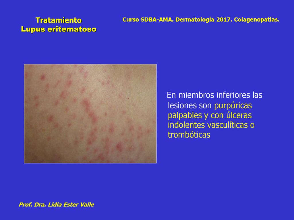 En miembros inferiores las lesiones son purpúricas palpables y con úlceras indolentes vasculíticas o trombóticas