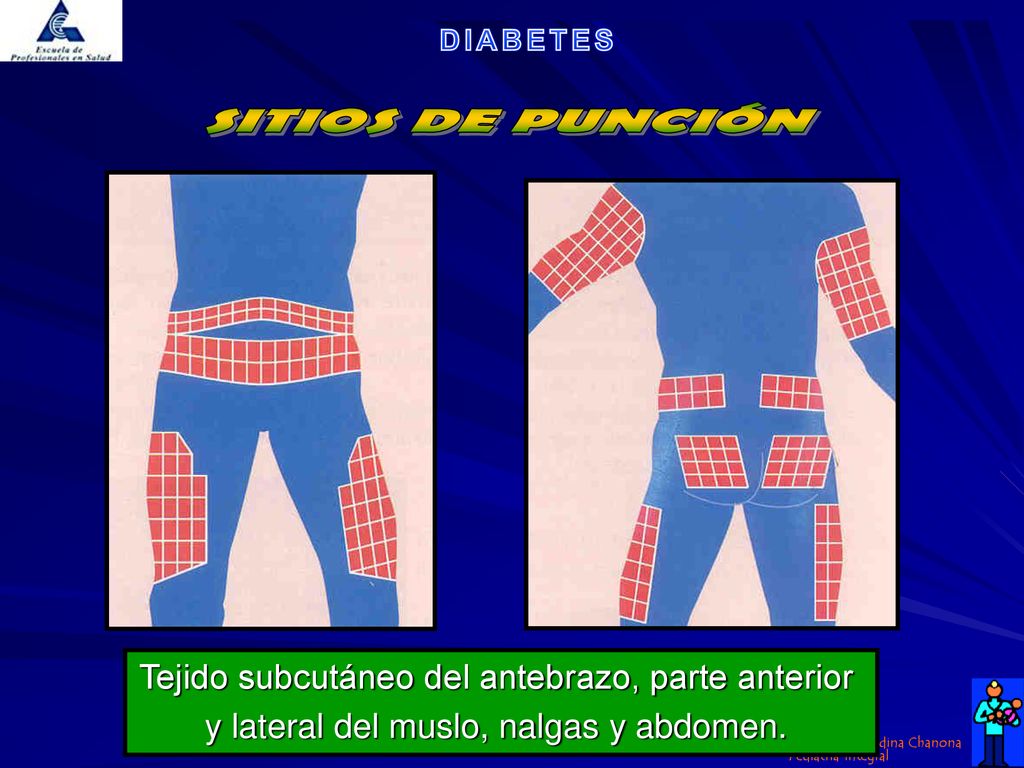 SITIOS DE PUNCIÓN Tejido subcutáneo del antebrazo, parte anterior