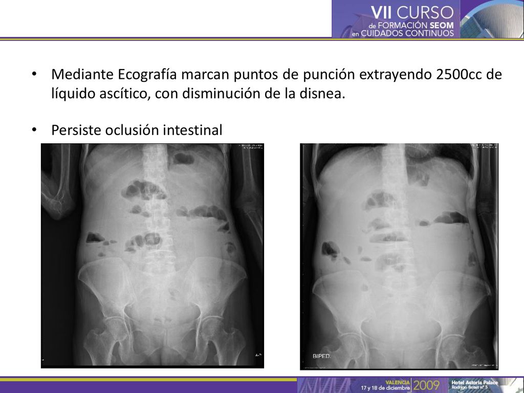 Mediante Ecografía marcan puntos de punción extrayendo 2500cc de líquido ascítico, con disminución de la disnea.