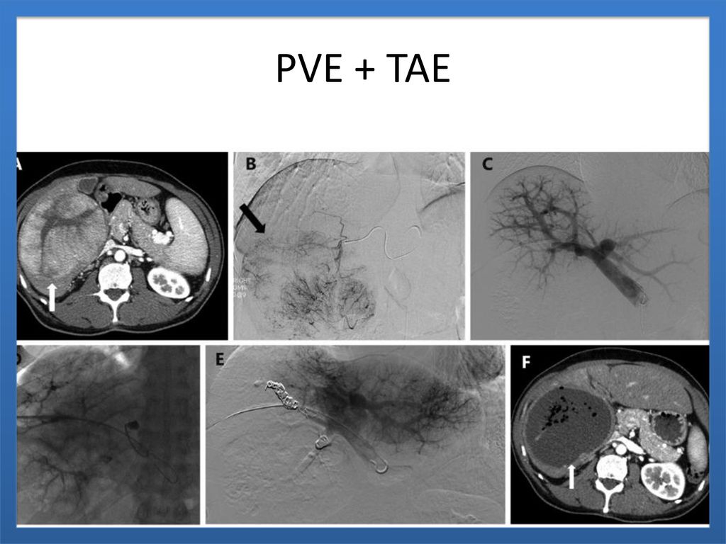 PVE + TAE DHC CHILD A, HCC 12 CM, TAE 1 MES PVE, HEPATECTOMIA DERECHA