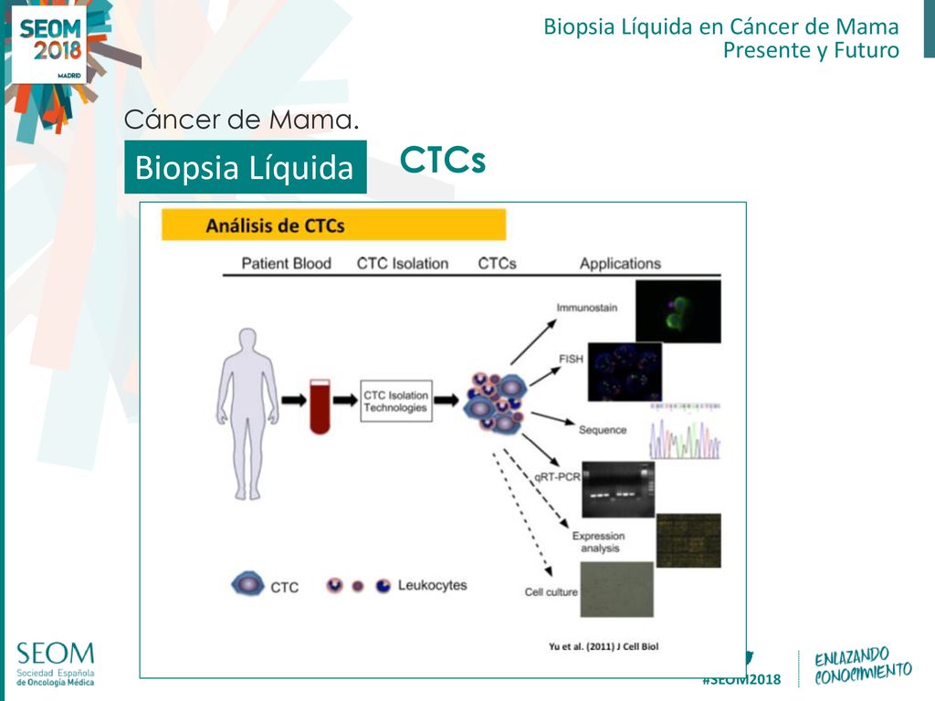 Biopsia Líquida CTCs Cáncer de Mama. Biopsia Líquida en Cáncer de Mama