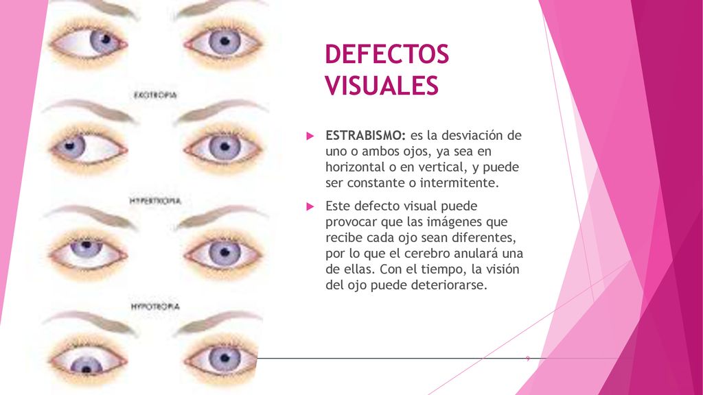 DEFECTOS VISUALES ESTRABISMO: es la desviación de uno o ambos ojos, ya sea en horizontal o en vertical, y puede ser constante o intermitente.