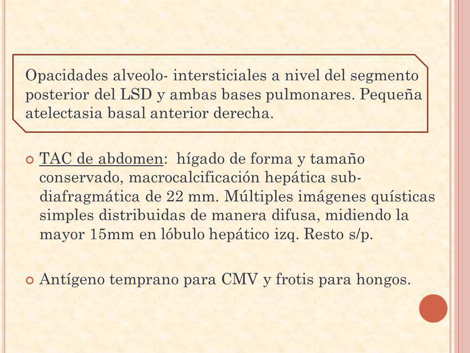 Opacidades alveolo- intersticiales a nivel del segmento posterior del LSD y ambas bases pulmonares. Pequeña atelectasia basal anterior derecha.