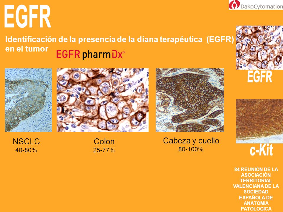 EGFR Identificación de la presencia de la diana terapéutica (EGFR) en el tumor. NSCLC % Colon.