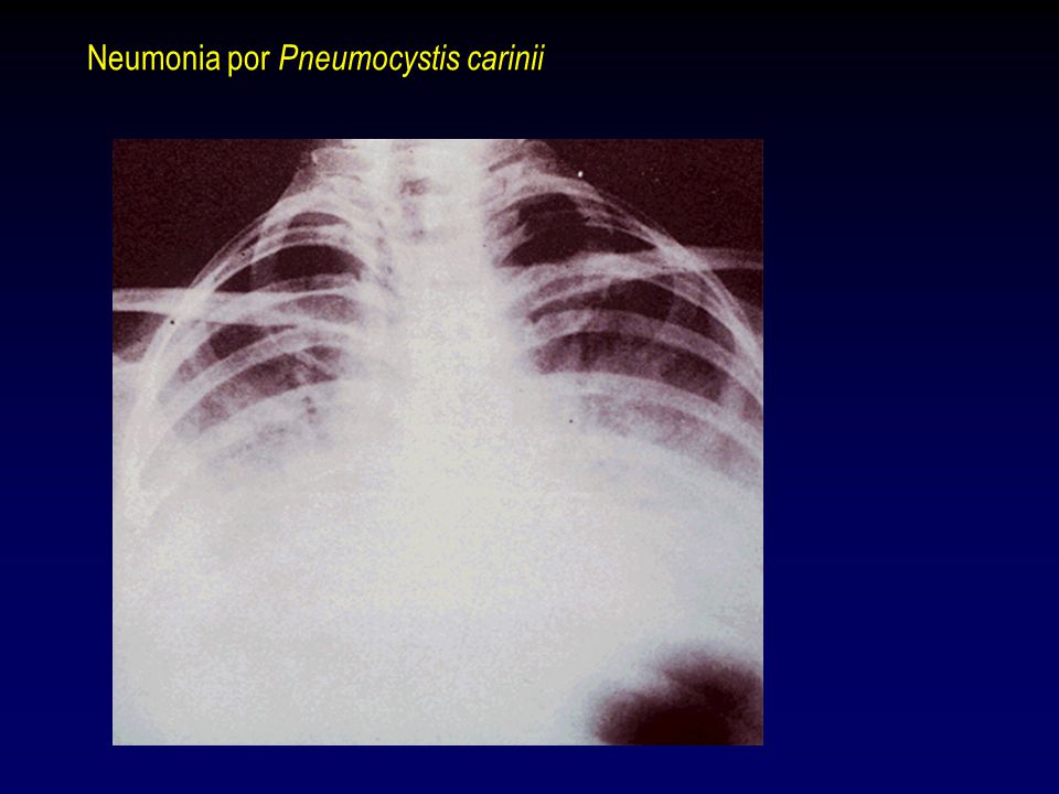 Neumonia por Pneumocystis carinii