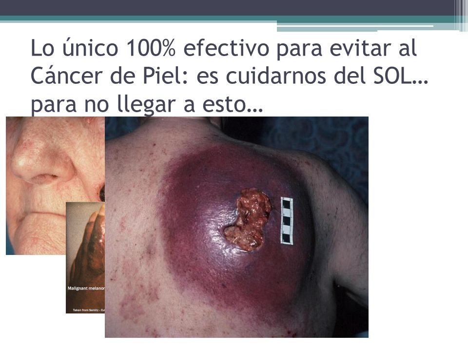 Lo único 100% efectivo para evitar al Cáncer de Piel: es cuidarnos del SOL… para no llegar a esto…